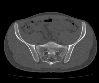 Anterior inferior iliac spine avulsion fracture (Radiopaedia 81312-94999 Axial bone window 30).jpg