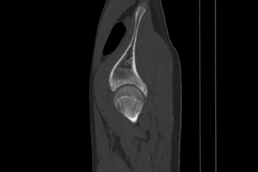 Anterior inferior iliac spine avulsion injury (Radiopaedia 88666-105376 Sagittal bone window 78).jpg