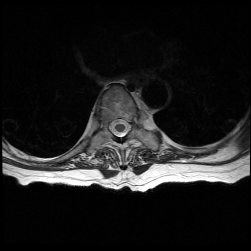 File:Anterior spinal artery syndrome (Radiopaedia 46335-50750 Axial T2 18).png