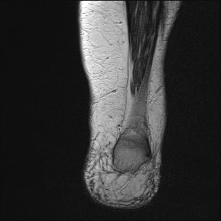 File:Anterior talofibular ligament injury - rupture with soft-tissue impingement (Radiopaedia 38765-40928 Coronal T2 3).jpg