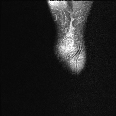 File:Anterior talofibular ligament injury - rupture with soft-tissue impingement (Radiopaedia 38765-40928 Sagittal PD fat sat 23).jpg