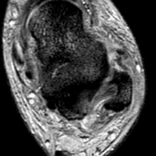 File:Anterior talofibular ligament rupture (Radiopaedia 15831-15484 Axial T2* 12).jpg