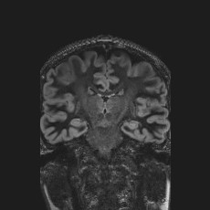 Anterior temporal encephalocele (Radiopaedia 82624-96808 Coronal FLAIR 28).jpg