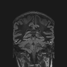 File:Anterior temporal encephalocele (Radiopaedia 82624-96808 Coronal FLAIR 33).jpg