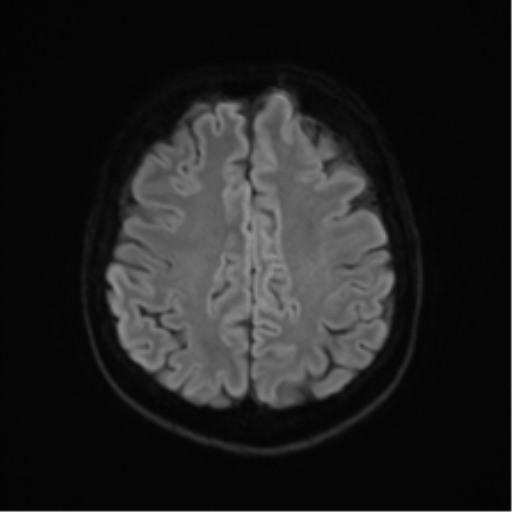 Anterior temporal lobe perivascular space (Radiopaedia 40946-43650 Axial DWI 47).png