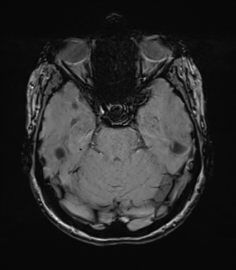 File:Anterior temporal lobe perivascular space (Radiopaedia 40946-43650 Axial SWI 28).png