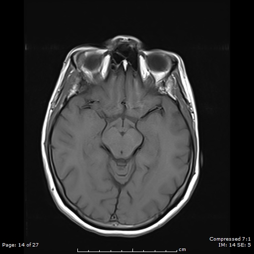 File:Anterior temporal lobe perivascular space (Radiopaedia 88283-104914 Axial T1 14).jpg