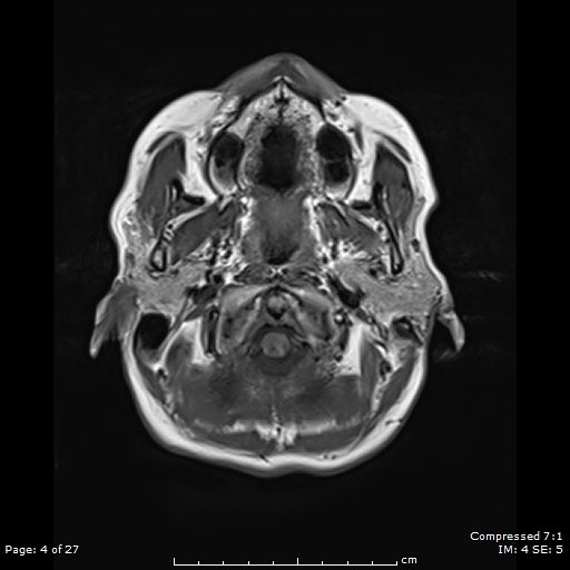 File:Anterior temporal lobe perivascular space (Radiopaedia 88283-104914 Axial T1 4).jpg