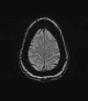 Anterior temporal pole cysts (Radiopaedia 46629-51102 Axial SWI 79).png