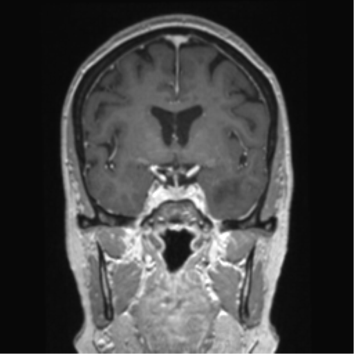 Anterior temporal pole cysts (Radiopaedia 46629-51102 Coronal T1 C+ 103).png