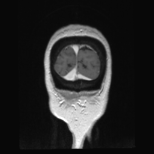 Anterior temporal pole cysts (Radiopaedia 46629-51102 Coronal T1 C+ 11).png