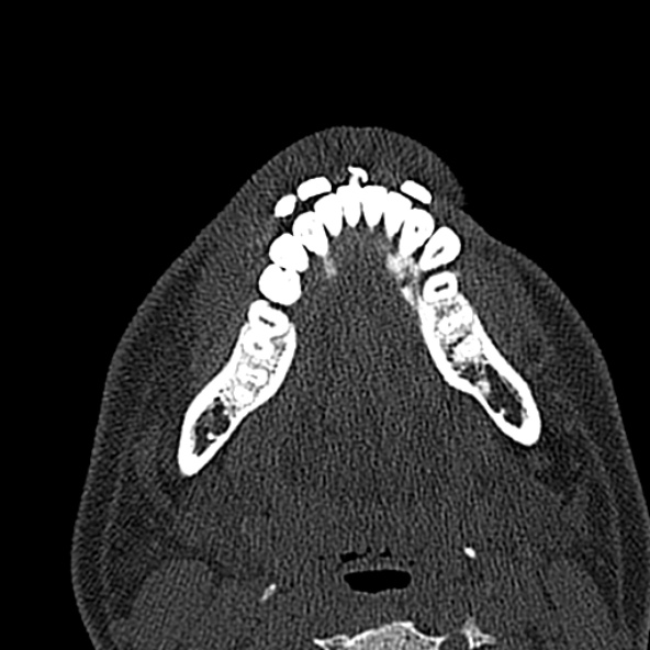 Antrochoanal polyp (Radiopaedia 30002-30554 Axial bone window 4).jpg