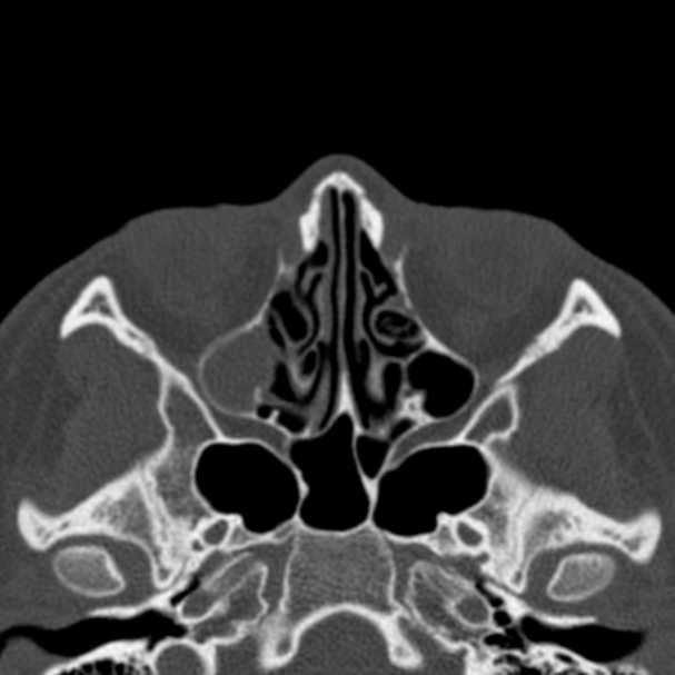 Antrochoanal polyp (Radiopaedia 33984-35202 Axial bone window 41).jpg