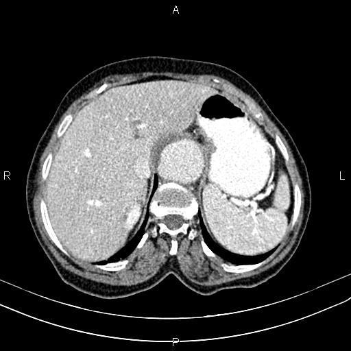 File:Aortic aneurysm and Lemmel syndrome (Radiopaedia 86499-102554 A 19).jpg