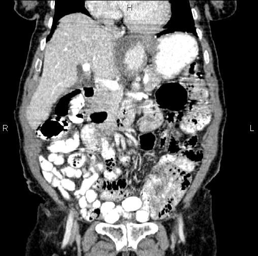 Aortic aneurysm and Lemmel syndrome (Radiopaedia 86499-102554 C 20).jpg