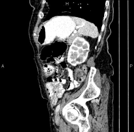 File:Aortic aneurysm and Lemmel syndrome (Radiopaedia 86499-102554 D 69).jpg