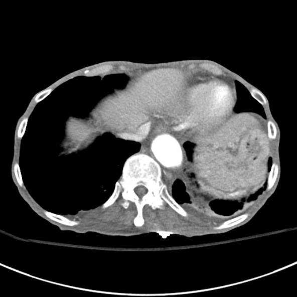 File:Aortic aneurysm with spinal destruction (Radiopaedia 42301-45410 A 10).jpg