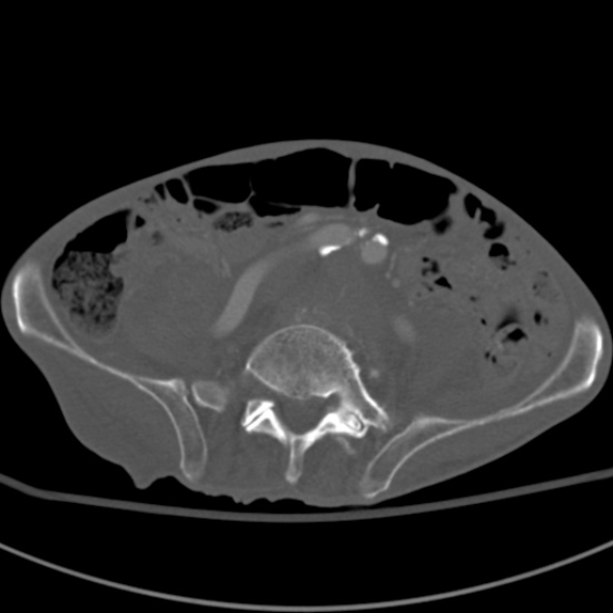 Aortic aneurysm with spinal destruction (Radiopaedia 42301-45410 Axial bone window 72).jpg