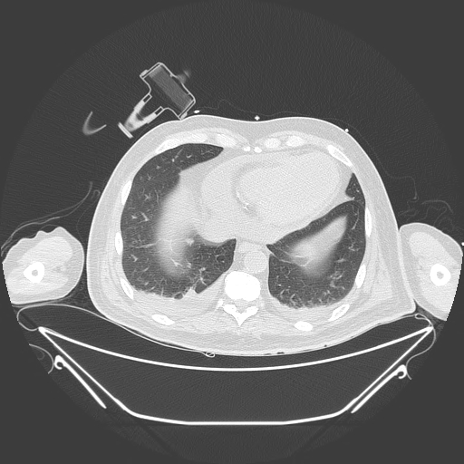 Aortic arch aneurysm (Radiopaedia 84109-99365 Axial lung window 214).jpg