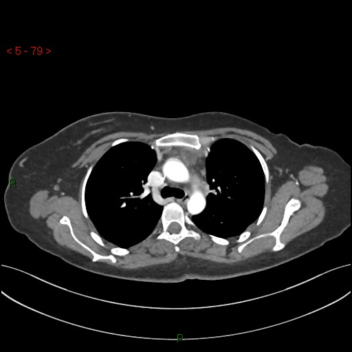 File:Aortic arch origin of left vertebral artery (Radiopaedia 51520-57286 A 78).jpg