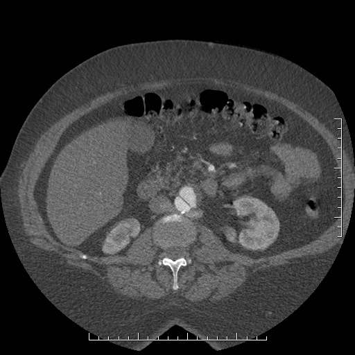 File:Aortic dissection- Stanford A (Radiopaedia 35729-37268 C 3).jpg
