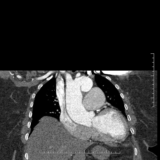 Aortic dissection- Stanford A (Radiopaedia 35729-37268 E 42).jpg