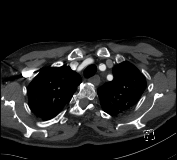 File:Aortic dissection (CTPA) (Radiopaedia 75506-86750 A 18).jpg