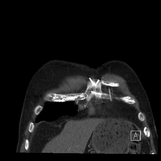 File:Aortic dissection (CTPA) (Radiopaedia 75506-86750 B 6).jpg