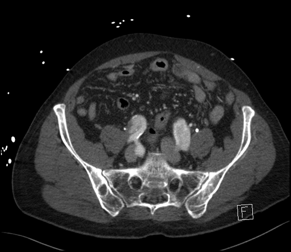 Aortic dissection (CTPA) (Radiopaedia 75506-86750 E 112).jpg