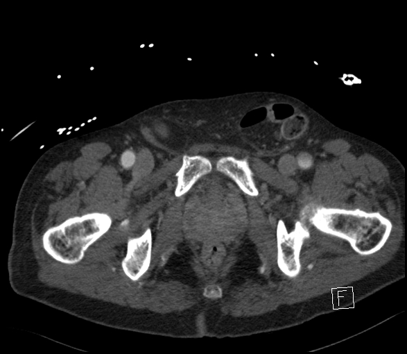Aortic dissection (CTPA) (Radiopaedia 75506-86750 E 152).jpg