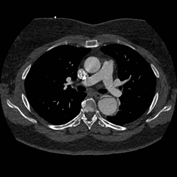 File:Aortic dissection (Radiopaedia 57969-64959 A 136).jpg