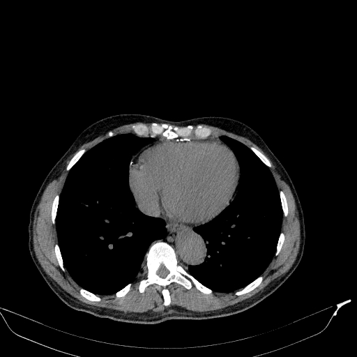 Aortic dissection - Stanford type A (Radiopaedia 83418-98500 Axial non-contrast 31).jpg