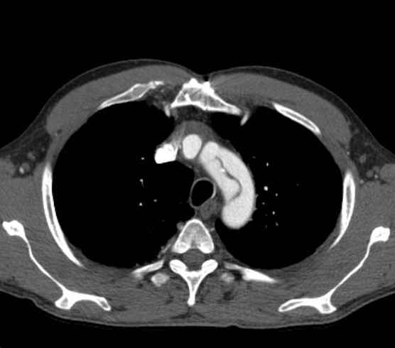 File:Aortic dissection - Stanford type B (Radiopaedia 73648-84437 A 15).jpg