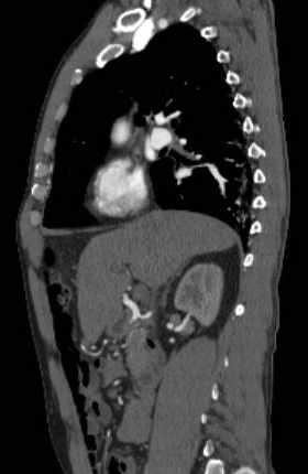 File:Aortic dissection - Stanford type B (Radiopaedia 73648-84437 C 98).jpg
