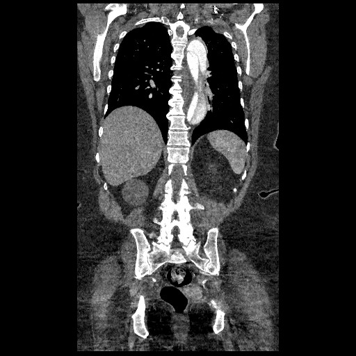 File:Aortic dissection - Stanford type B (Radiopaedia 88281-104910 B 62).jpg