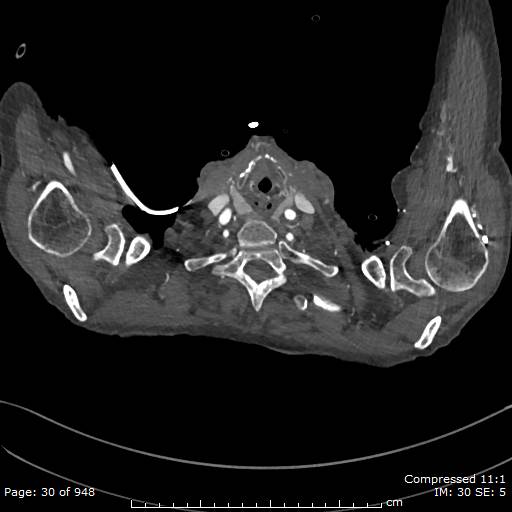 Aortic dissection with extension into aortic arch branches (Radiopaedia 64402-73204 B 30).jpg
