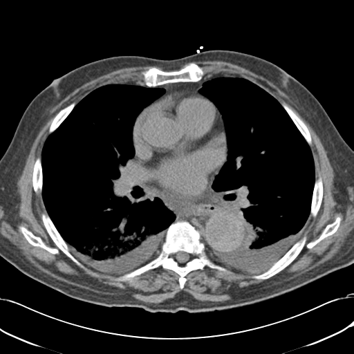 Aortic intramural hematoma (Radiopaedia 34260-35540 Axial non-contrast 33).png