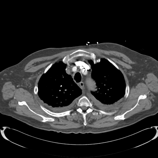 Aortic intramural hematoma (Radiopaedia 34260-35540 B 6).png
