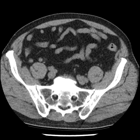 Aortic intramural hematoma (type B) (Radiopaedia 79323-92387 Axial non-contrast 94).jpg