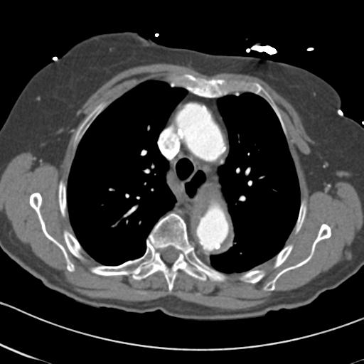 File:Aortic intramural hematoma from penetrating atherosclerotic ulcer (Radiopaedia 31137-31836 A 25).jpg