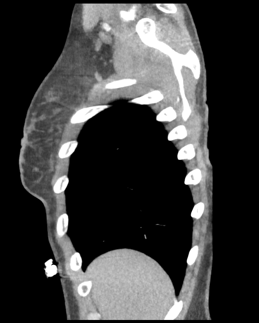 Aortic valve non-coronary cusp thrombus (Radiopaedia 55661-62189 D 47).png