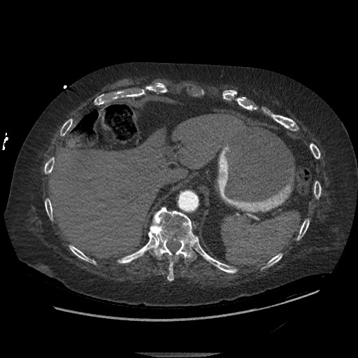 Aortoesophageal fistula with endovascular repair (Radiopaedia 73781-84592 Axial C+ CTPA 160).jpg
