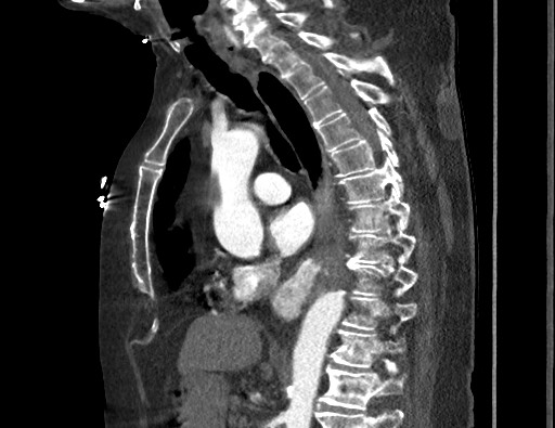 Aortoesophageal fistula with endovascular repair (Radiopaedia 73781-84592 Sagittal C+ CTPA 101).jpg