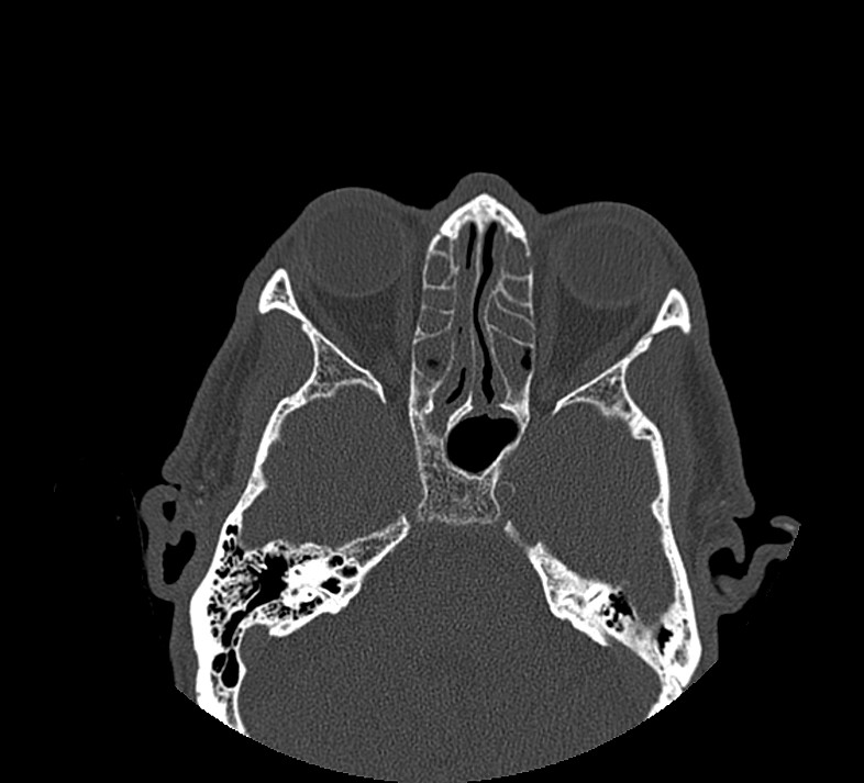 Aplastic maxillary sinuses (Radiopaedia 60030-67561 Axial non-contrast 46).jpg