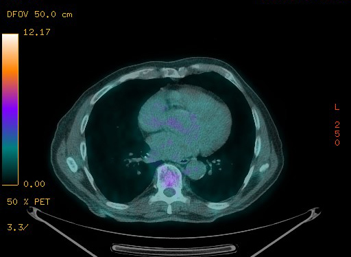 Appendiceal adenocarcinoma complicated by retroperitoneal abscess (Radiopaedia 58007-65041 Axial PET-CT 78).jpg