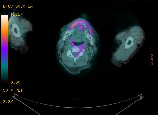 Appendiceal adenocarcinoma complicated by retroperitoneal abscess (Radiopaedia 58007-65041 Axial PET-CT 8).jpg