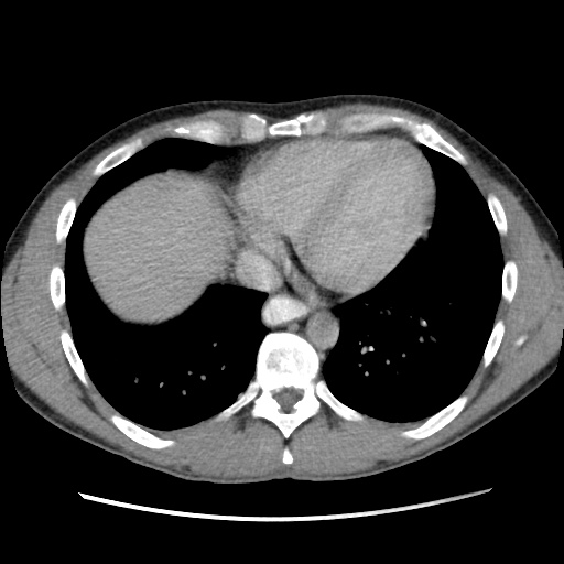 File:Appendicitis complicated by post-operative collection (Radiopaedia 35595-37114 A 8).jpg