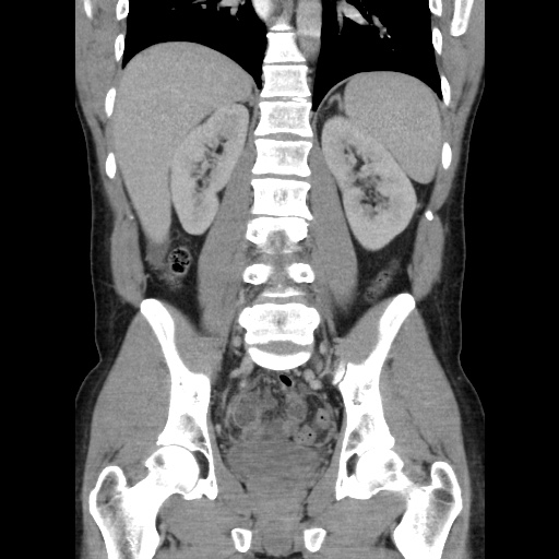 Appendicitis complicated by post-operative collection (Radiopaedia 35595-37114 B 36).jpg