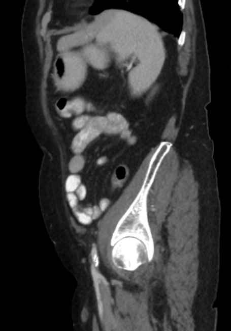 Appendicitis due to chicken fibula (Radiopaedia 74314-85198 C 80).jpg