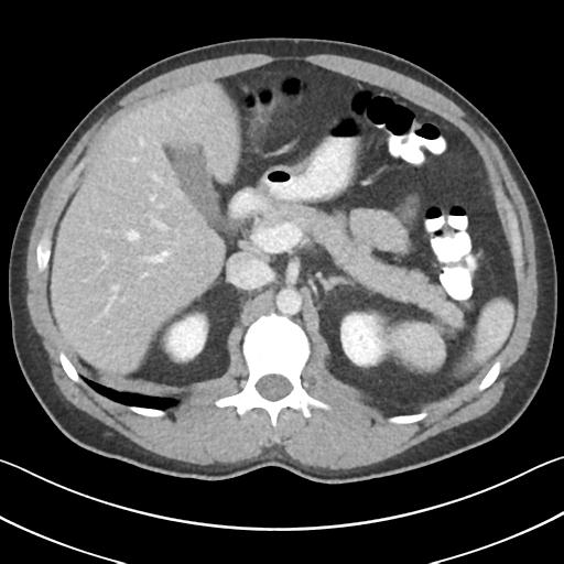 Appendicitis with cecal bar sign (Radiopaedia 31878-32830 B 26).jpg